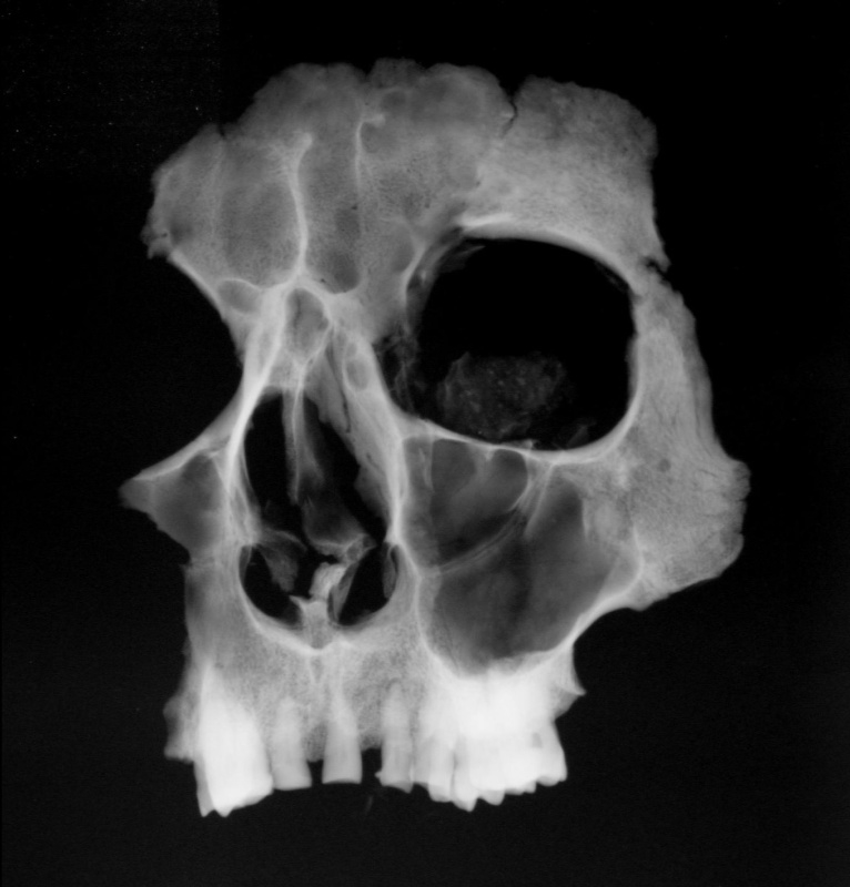 X-ray picture of maintained facial part of Tycho Brahe (photography:National Museum archive)
